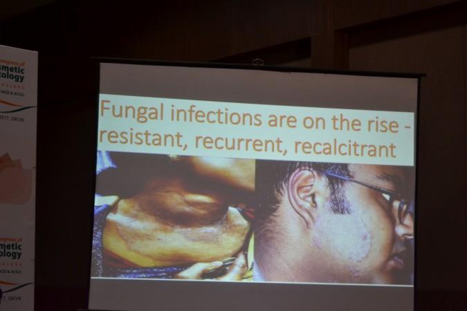 fungal infections, skincare, steroids, dermatologist, health,