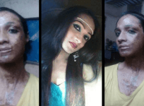 Sonia Sheikh- acid attack survivor from Hyderabad