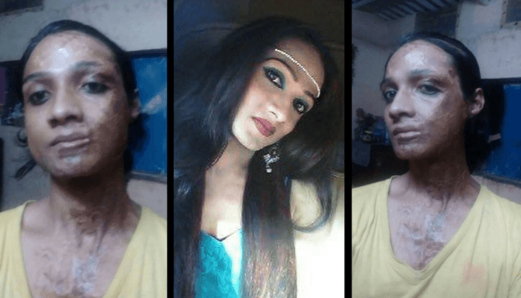 Sonia Sheikh Sonia Sheikh- acid attack survivor from Hyderabad