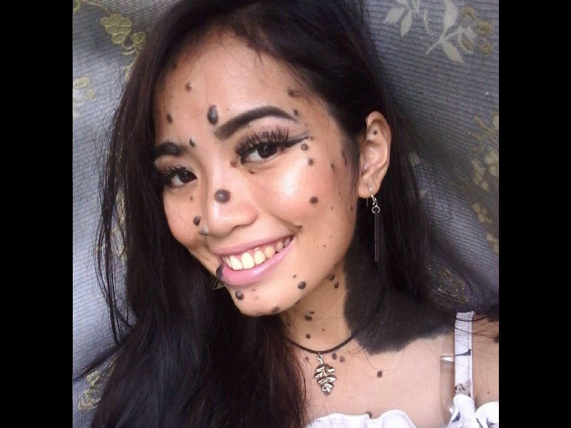 Girl, Bullied As Monster Over Excessive Moles, May -5483