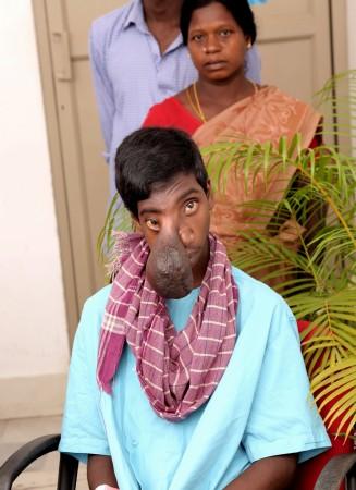 Manikandan before operation. rare surgery, rare condition, encephlocele , tribal boy, kerela,