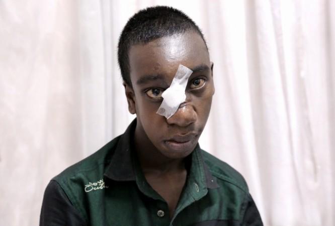 rare surgery, rare condition, encephlocele , tribal boy, kerela,