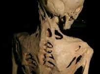 rare disorder, genetic,