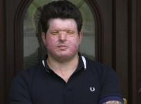 Acid attack victim calls for tougher sentences
