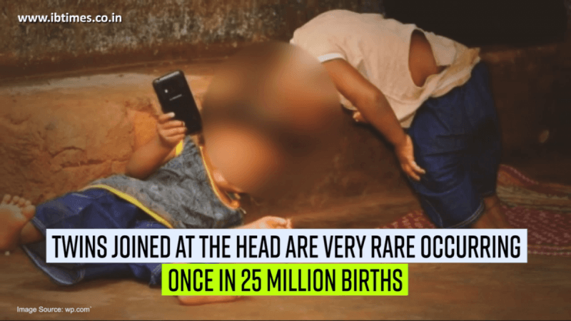 Twins joined at the head are very rare, occurring once in 25 million live births