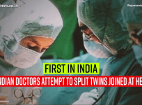 First in India, Indian doctors attempt to split twins joined at head