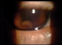 Worm digs holes in teens eye for weeks