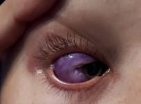 Bizarre eyeball tattoo leaves Canadian model partially blind