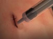 surgical glue, surgery, health,