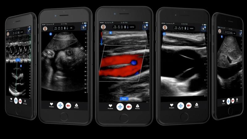 Image generated by ultrasound machine seen on iPhone screen Image generated by ultrasound machine seen on iPhone screen