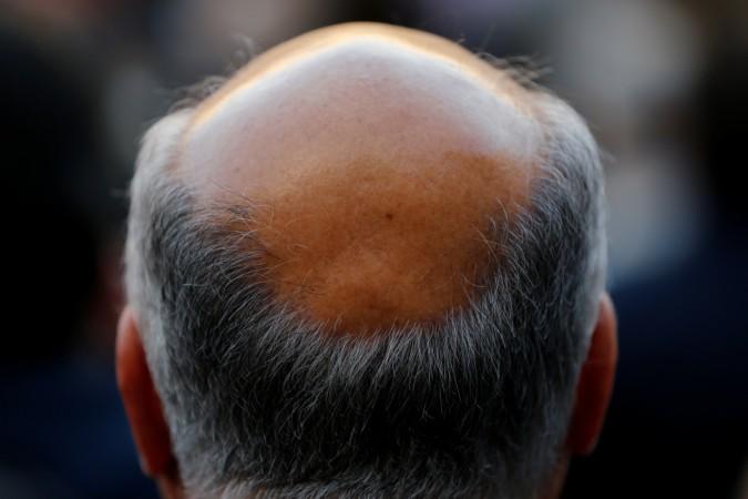 A man with baldness is seen in Seville, southern Spain April 6, 2016.