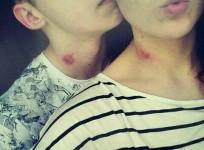 love bite, sex,