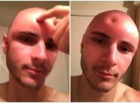 dent in head