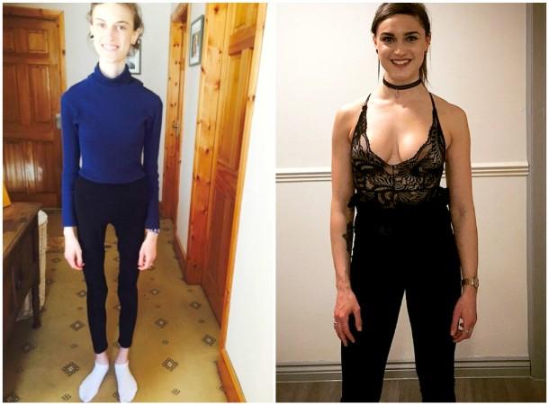 Emelle, before (L) and after (R) recovering from Anorexia. emelle lewis