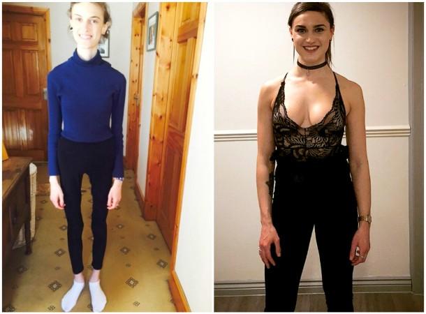 anorexia before and after pictures of people with anorexia