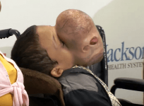 emanuel tumour