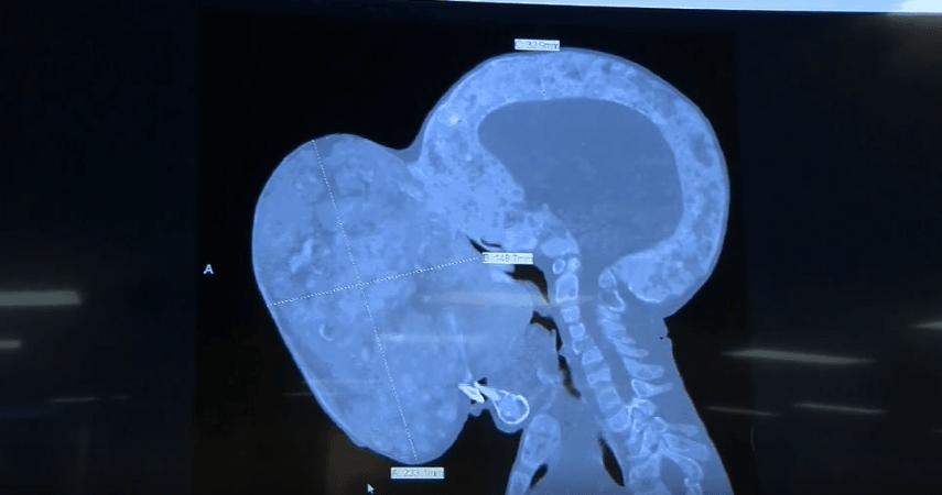 The doctors in Cuba were able to control Emanuel's symptoms until the age of nine, but once his skull began to swell and deform, it was beyond their hands. emanuel's tumour