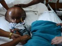 HYDROCEPHALUS