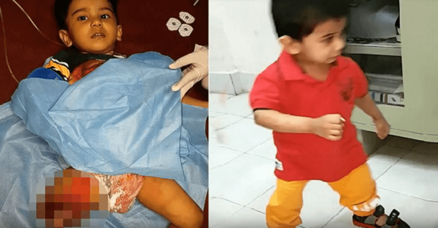 Two-year-old Mohammed Saleh took his first steps, after surgeons reattached his limbs which had been cut off in a train accident. indian boy