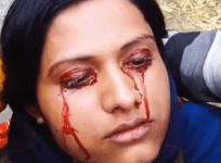 woman sweats blood