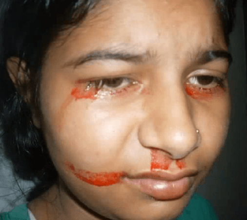 Eighteen-year-old Preeti Gupta, from Delhi, India had also mysteriously started bleeding from her skin back in 2009, when she was a little child. preeti gupta