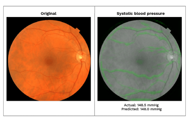 LEFT: image of the back of the eye showing the macula (dark spot in the middle), optic disc (bright spot at the right), and blood vessels (dark red lines arcing out from the bright spot on the right). RIGHT: retinal image in gray, with the pixels used by the deep learning algorithm to make predictions about the blood pressure highlighted in shades of green (heatmap). We found that each CV risk factor prediction uses a distinct pattern, such as blood vessels for blood pressure, and optic disc for other predictions. Google and Verily