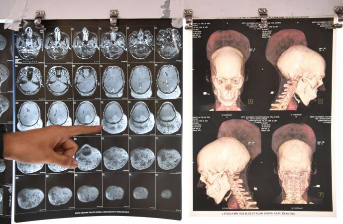 Indian doctor Ramanuj Kabra points to brain scans of Santlal Pal, 31, at the BYL Nair hospital in Mumbai on February 22, 2018. Indian surgeons who removed a massive brain tumor in a marathon seven-hour procedure said on February 22 it could be the heaviest ever recorded. Santlal had been carrying around a tumor weighing nearly two kilos before the surgery on February 14. Indian doctor Ramanuj Kabra points to brain scans of Santlal Pal, 31, at the BYL Nair hospital in Mumbai on February 22, 2018. Indian surgeons who removed a massive brain tumour in a marathon seven-hour procedure said on February 22 it could be the heavie