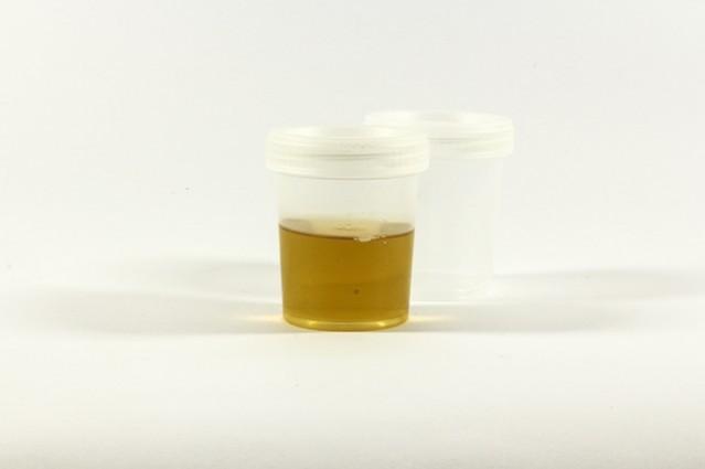 Representational image of a urine sample. Urine test