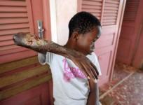 Buruli ulcer, flesh eating bacteria