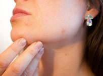Skin disease