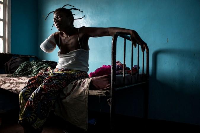 A Congolese woman, who has had her arm amputated after a gun shot wound, sits on her bed on October 23, 2017 in Tshikapa. Congo War