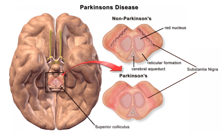 Parkinson's is a disorder of the central nervous system that affects movement, often including tremors. Parkinson's disease