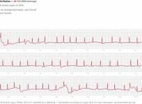 Apple, Watch Series 4, ECG, AFib, reading,