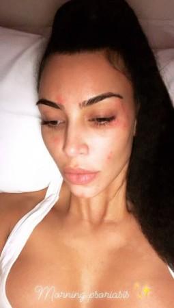 Kim Kardashian psoriasis Kim Kardashian psoriasis