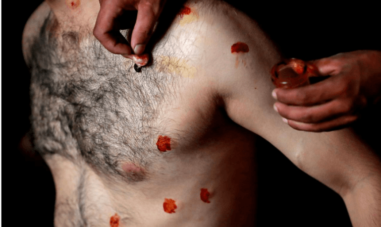 A man with pellet injuries is treated inside a house in a neighbourhood where there have been regular clashes with Indian security forces following restrictions after the government scrapped the special constitutional status for Kashmir, in Srinagar August 14, 2019. kashmir pellet injuries