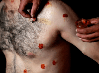 kashmir pellet injuries