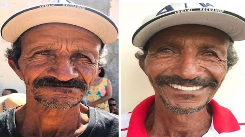 Before and after images of Dr. Fossi's client. Brazil Dentist Felipe Rossi