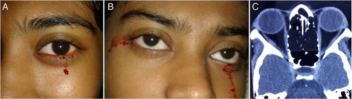 Rare medical condition of a girl who cries tears of blood Rare medical condition of a girl who cries tears of blood