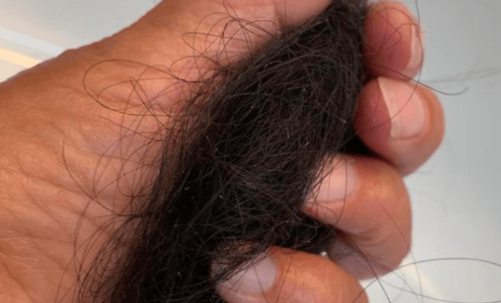 Hair Loss - Harvard Health