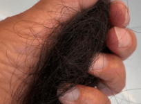 Covid hair loss
