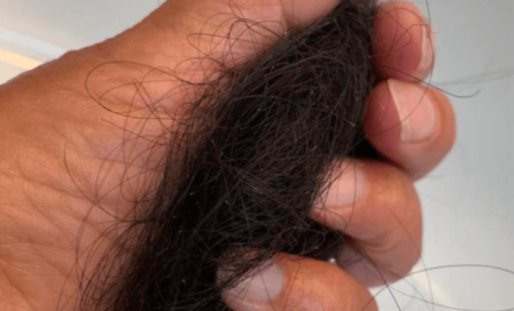 Covid hair loss Covid hair loss