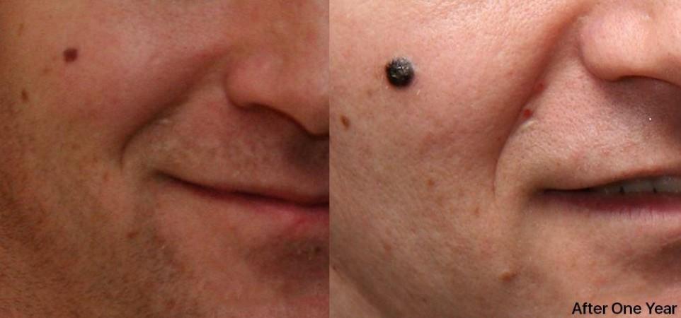 Nodular melanoma growth (Representational Picture) melanoma