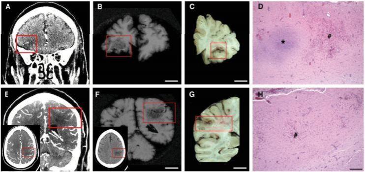 Acute, focal hemorrhagic infarcts in COVID-19 patients Corona brain