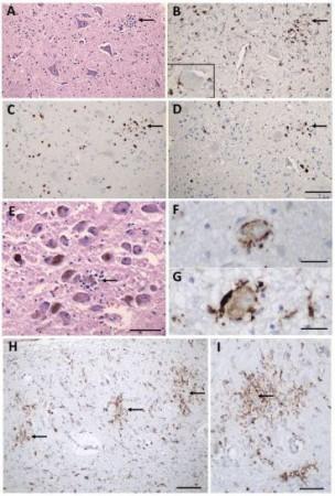 Inflammatory pathology in COVID-19 brains Corona brain and lung cells