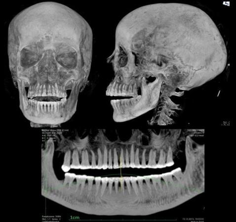 X-ray of the mummy's skull Pregnant Mummy