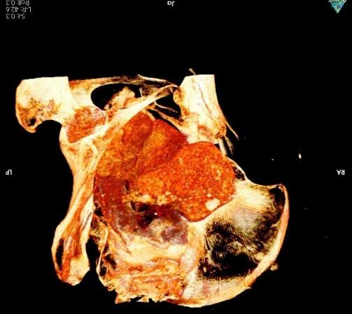 CT scan of the mummy's abdomen showing the fetus Pregnant Mummy
