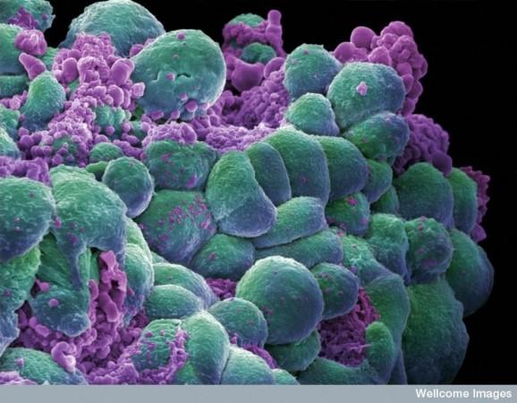 Breast Cancer Cells (Representational Picture) Breast Cancer