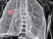 Lung Cancer