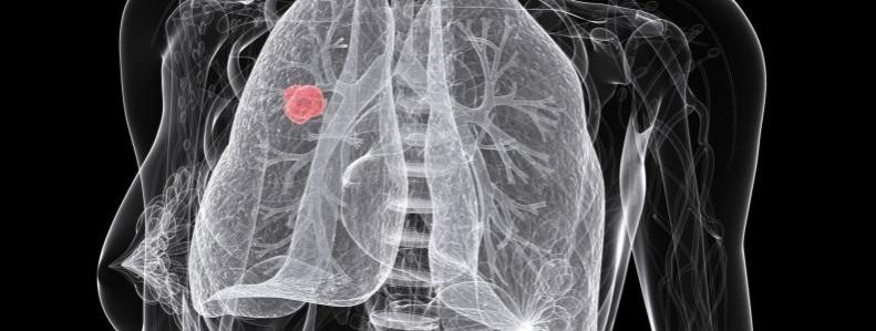 Non-small cell lung cancer (Representational Picture) Lung Cancer