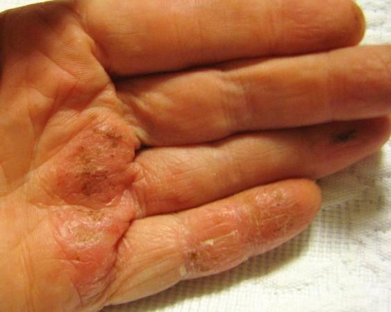 Atopic dermatitis is a complex disease presenting with a range of clinical manifestations and symptoms, depending on the patient demographic and disease severity Dermatitis